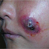 Staph infection of facial cheek