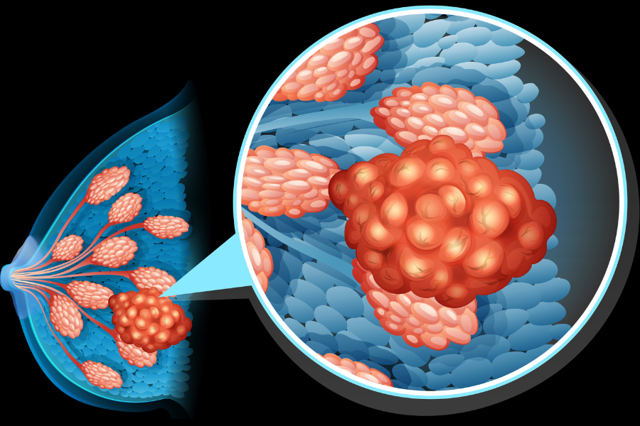 Diagram showing a breast with cancer cells.