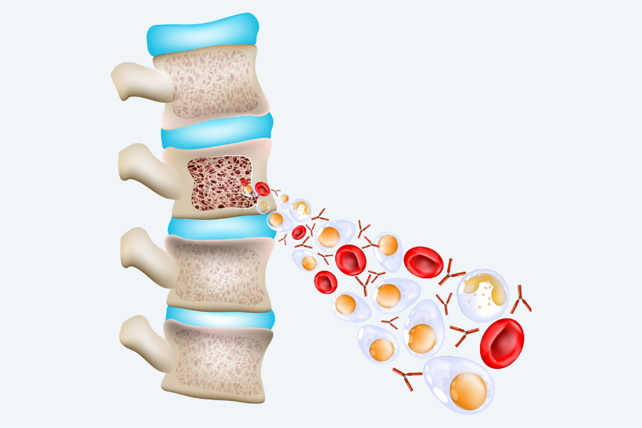 Diagram showing cancerous plasma cells in the bone marrow, highlighting how they affect the bone marrow environment.