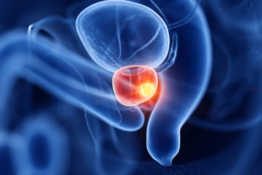 Diagram of an enlarged prostate with malignant tumors.