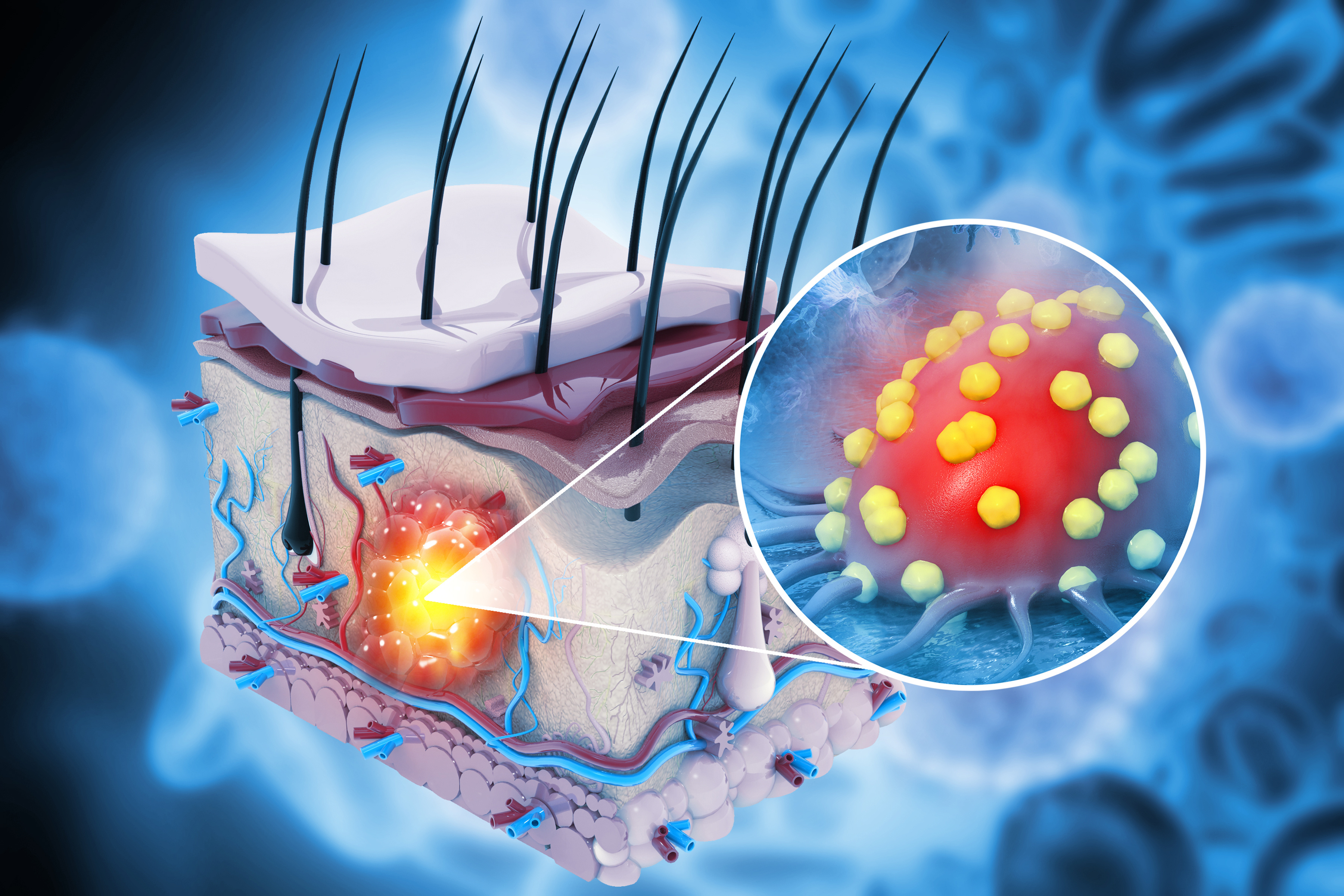 Skin cancer, spreading of cancer cell in human skin layer