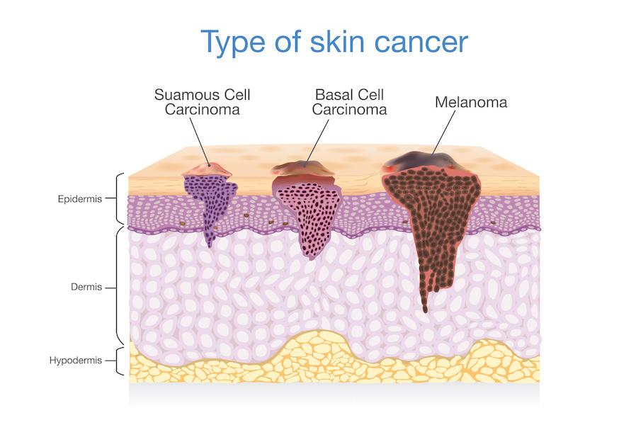 Type of skin cancer