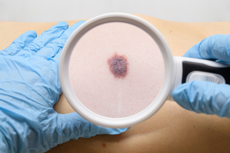 Melanoma: The Risk Is Real