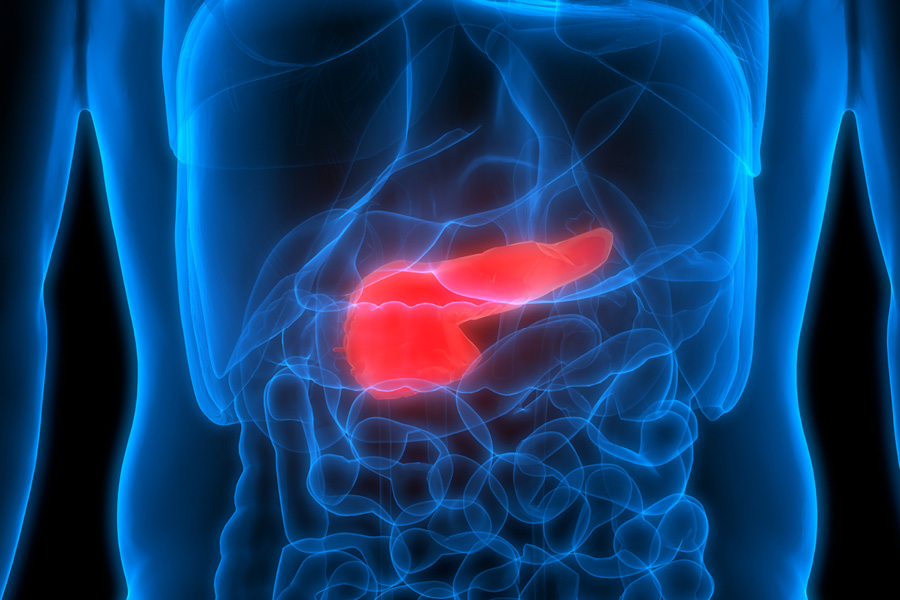 Pancreatogenic Diabetes