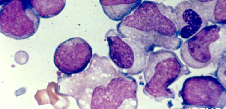 AML-M2