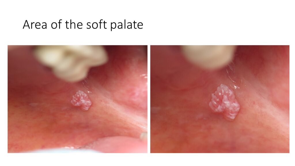 verrucous carcinoma palate