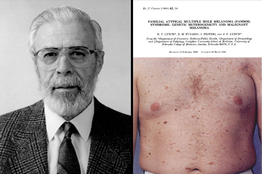 Dr. Ramon Fusaro and Familial Atypical Multiple Mole Melanoma
