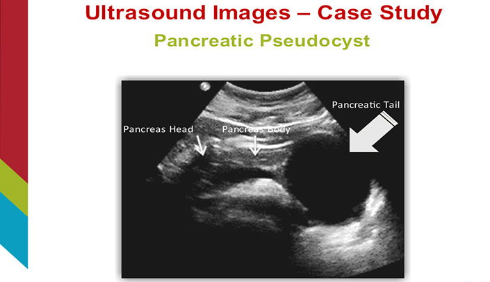 Pancreatic Pseudocyst Ultrasound Pancreatic Pseudocyst Ultrasound