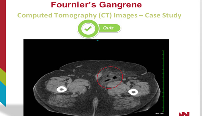 Image: Fournier Gangrene (X-Ray) - Merck Manuals Professional Edition