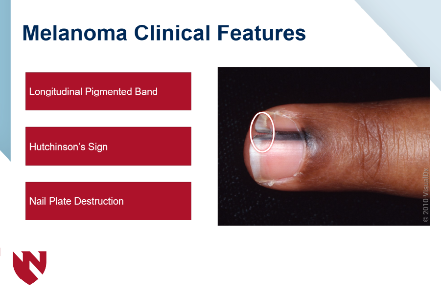 Module screenshot showing melanoma clinical features