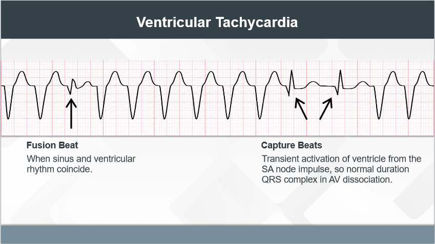 Ventricular Tachycardia. Fusion beat-when sinus and ventricular coincide. Capture Beats-Transient activation of ventricle from the SA node impulse, so normal duration QRS complex in AV dissociation.