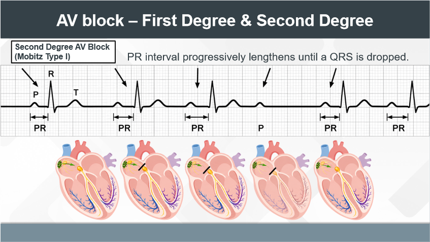 ECG Part 3