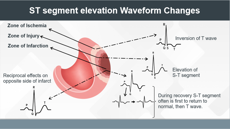 ECG Part 4