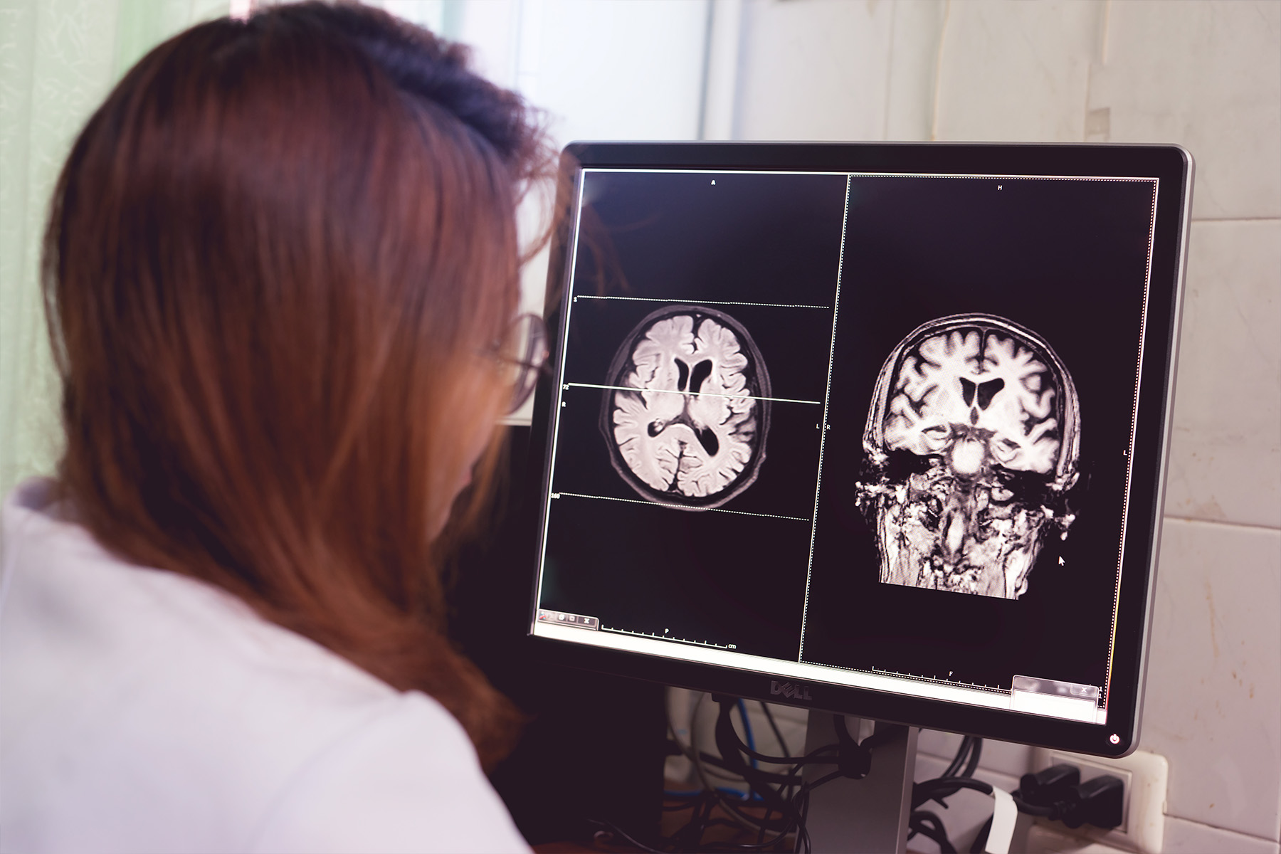 Woman sits in front of computer screen that has an MRI scan of a brain with Alzheimer's.