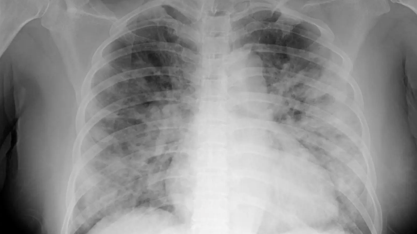 Chest CTs Reveal Abnormalities 2 Years After Severe COVID The