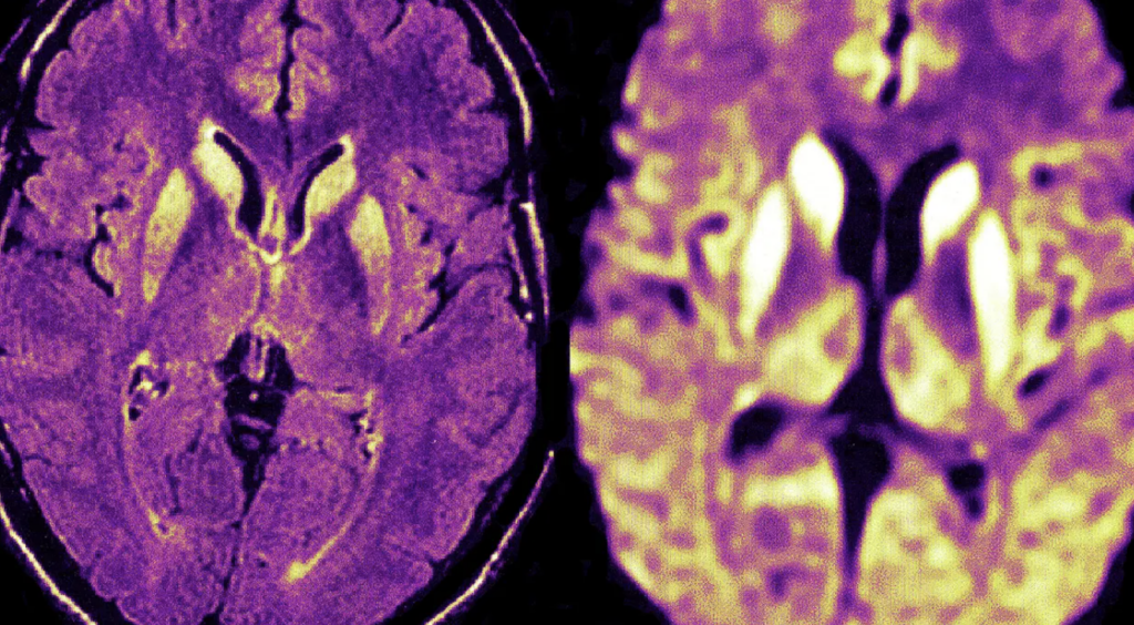 Prion Disease Rising in the U.S. | The Transmission | University of ...