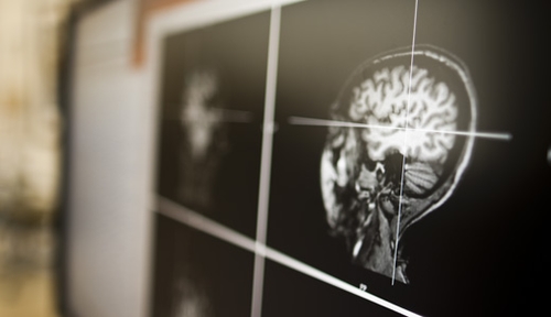 The magnetoencephalography (MEG) scanner is a brain imaging device that allows researchers to see the brain in action.