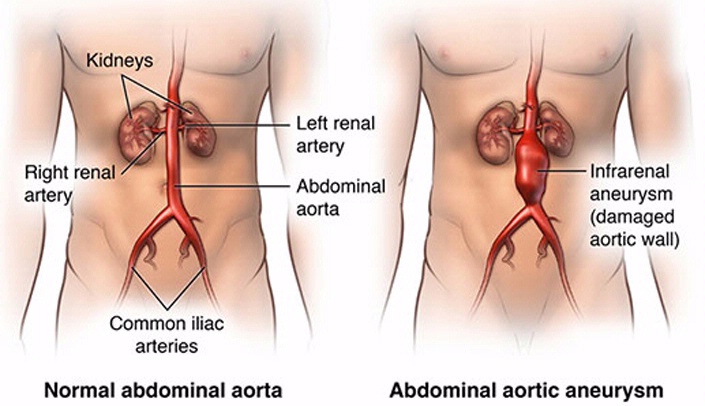 An abdominal aortic aneurysm is a ballooning of the abdominal aorta, the chief carrier of blood to the lower part of the body, placing it at risk of rupturing.