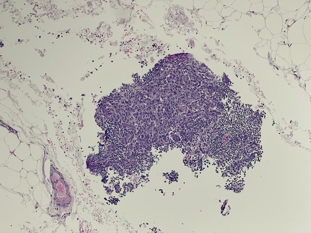 Photomicrograph of unexpected tissue in a surgical pathology specimen