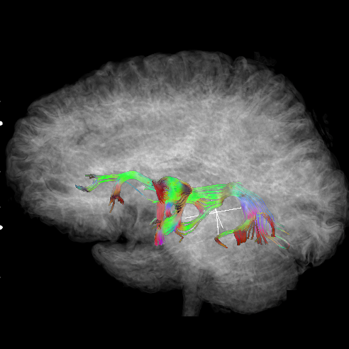 Tractography of the Arcuate Fasciculus