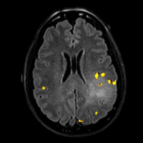 This is a T2–FLAIR image with language activation (yellow areas) seen adjacent to the hyperintense lesion on the left.  This means the language functional cortex would be at risk with resection of this mass since language activation is right at the edge of the mass and activation is also present within the center of the lesion.