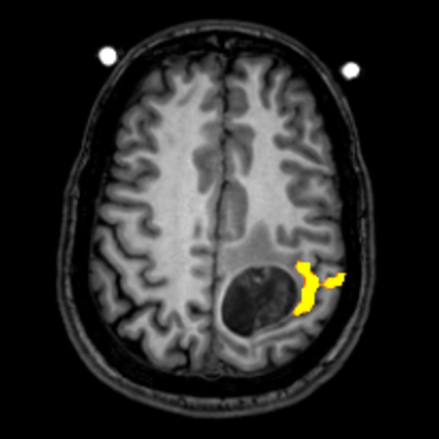 T1 FLAIR image with a mass demonstrated in the left posterior frontal lobe.  The fMRI activation (yellow) is seen at the edge of the lesion.  The area of activation was created with right finger tapping. This indicates the mass is in the motor strip and alerts the neurosurgeon to the risk of creating motor deficits at surgery.
