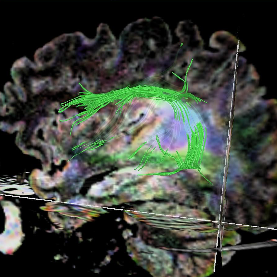This is a sagittal T2-FLAIR image of the same patient seen in figure 1.  The arcuate fasciculus (green fibers) is seen to wrap around the T2-FLAIR hyperintense mass.  The arcuate fasciculus connects regions of the brain involved in language.  This again indicates that in this patient resection of the mass would likely cause language deficits secondary to the mass extensively abutting the arcuate fasciculus.  